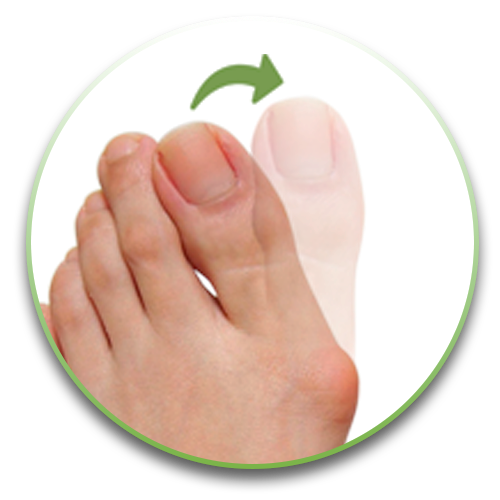 réalignement hallux valgus  orteils